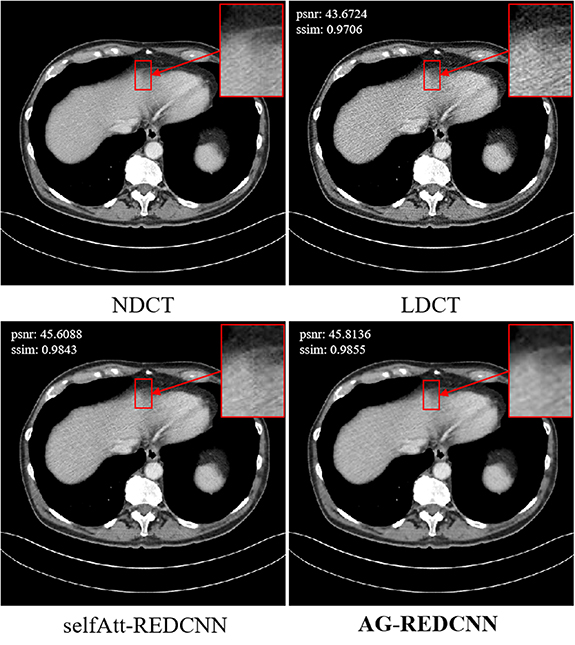 Self-supervised learning for low-dose CT image denoising method based ...