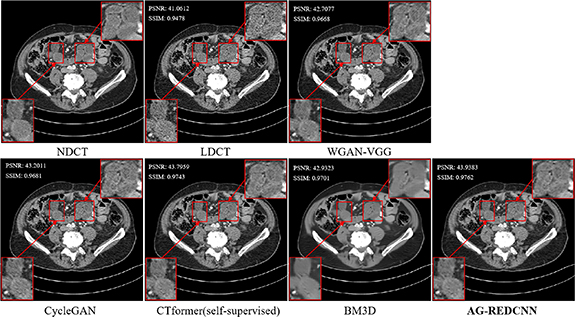 Self-supervised learning for low-dose CT image denoising method based ...