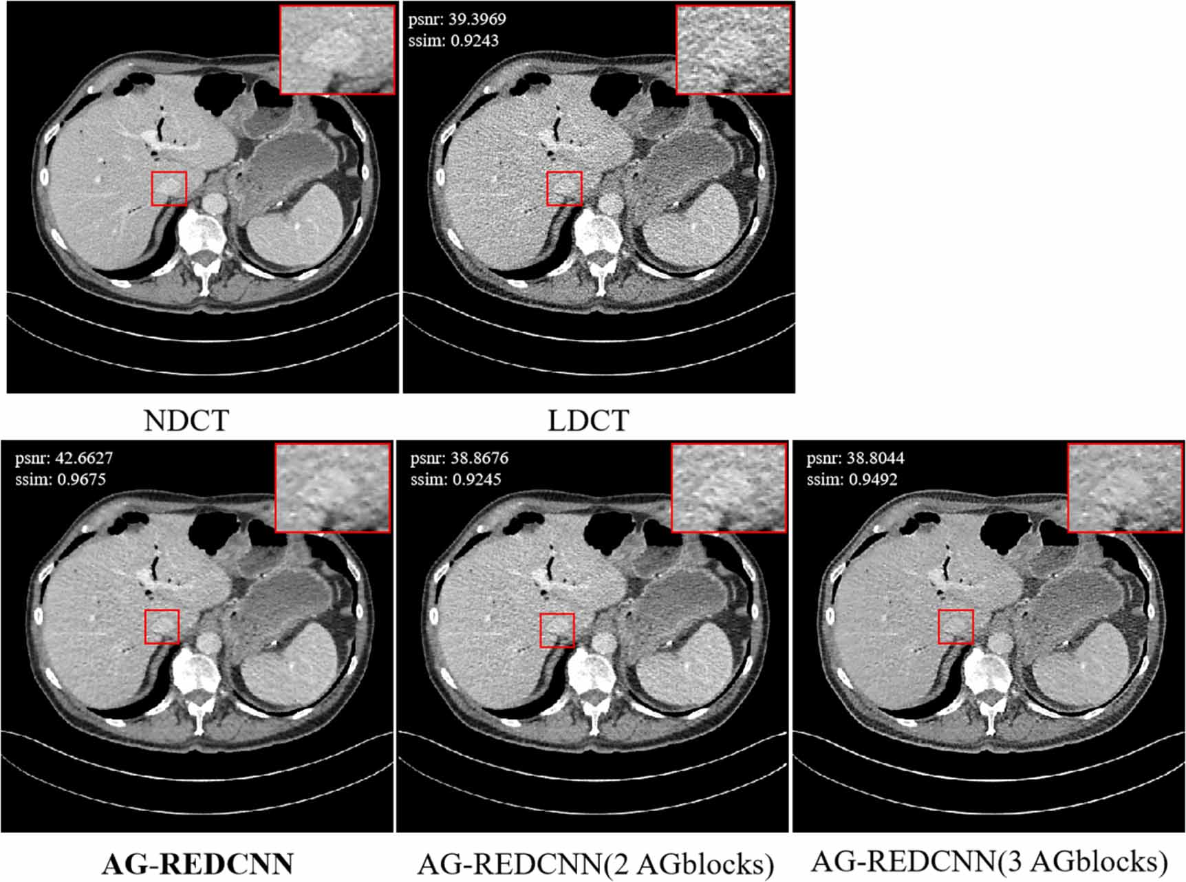 Self-supervised learning for low-dose CT image denoising method based ...