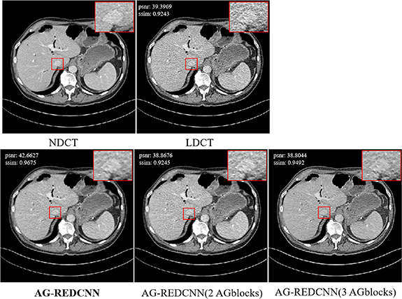 Self-supervised learning for low-dose CT image denoising method based ...