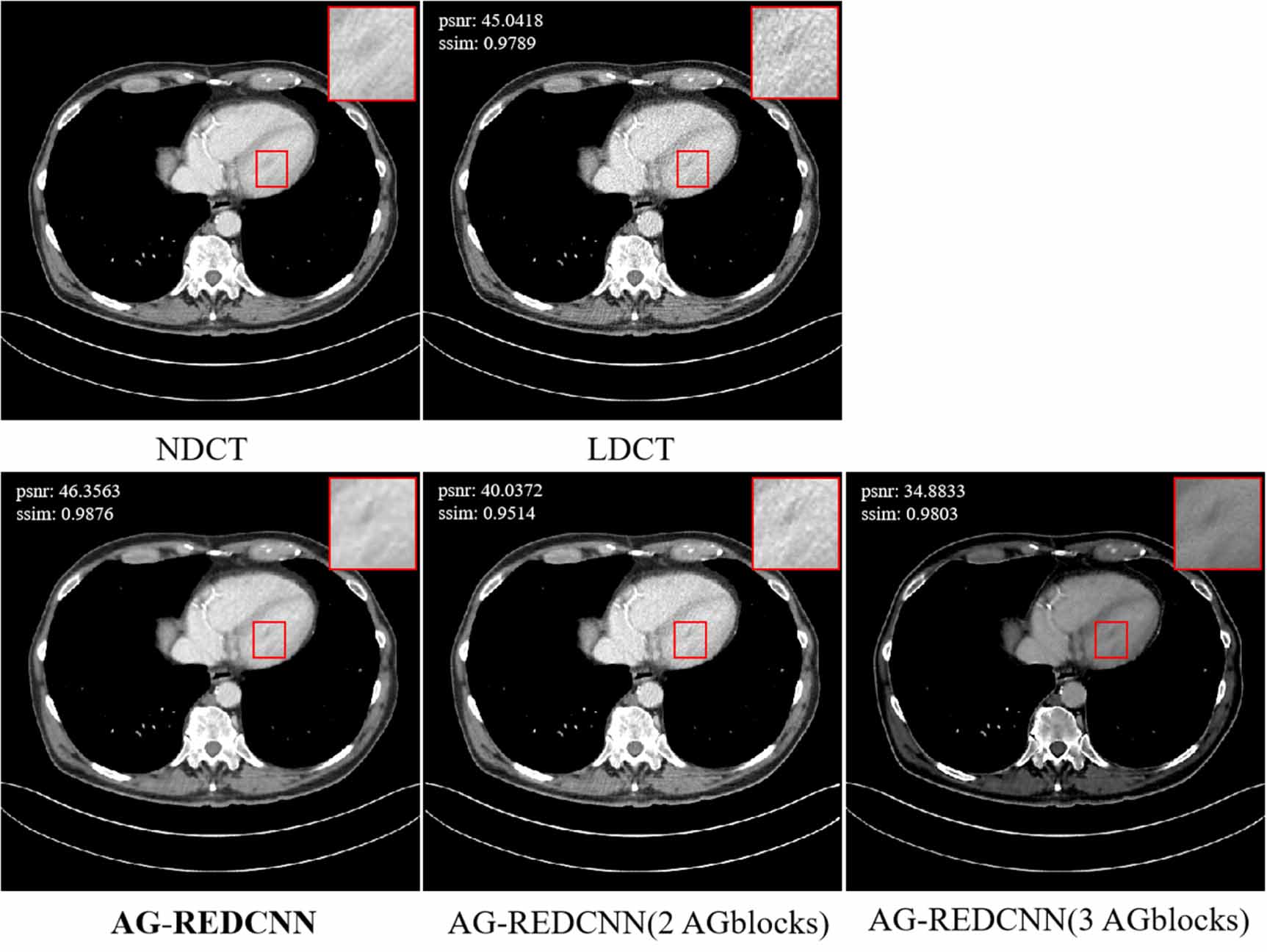 Self-supervised learning for low-dose CT image denoising method based ...