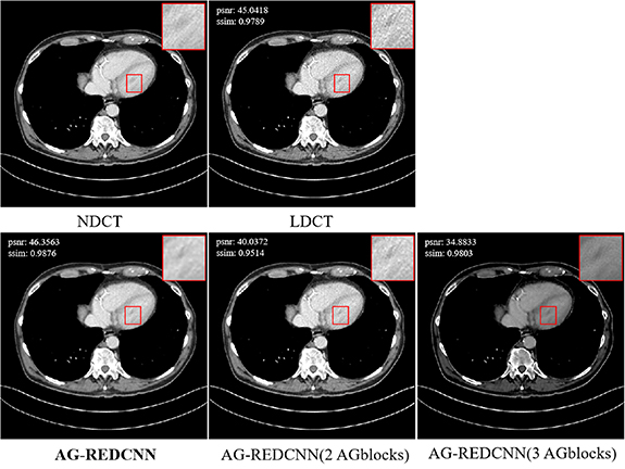 Self-supervised learning for low-dose CT image denoising method based ...