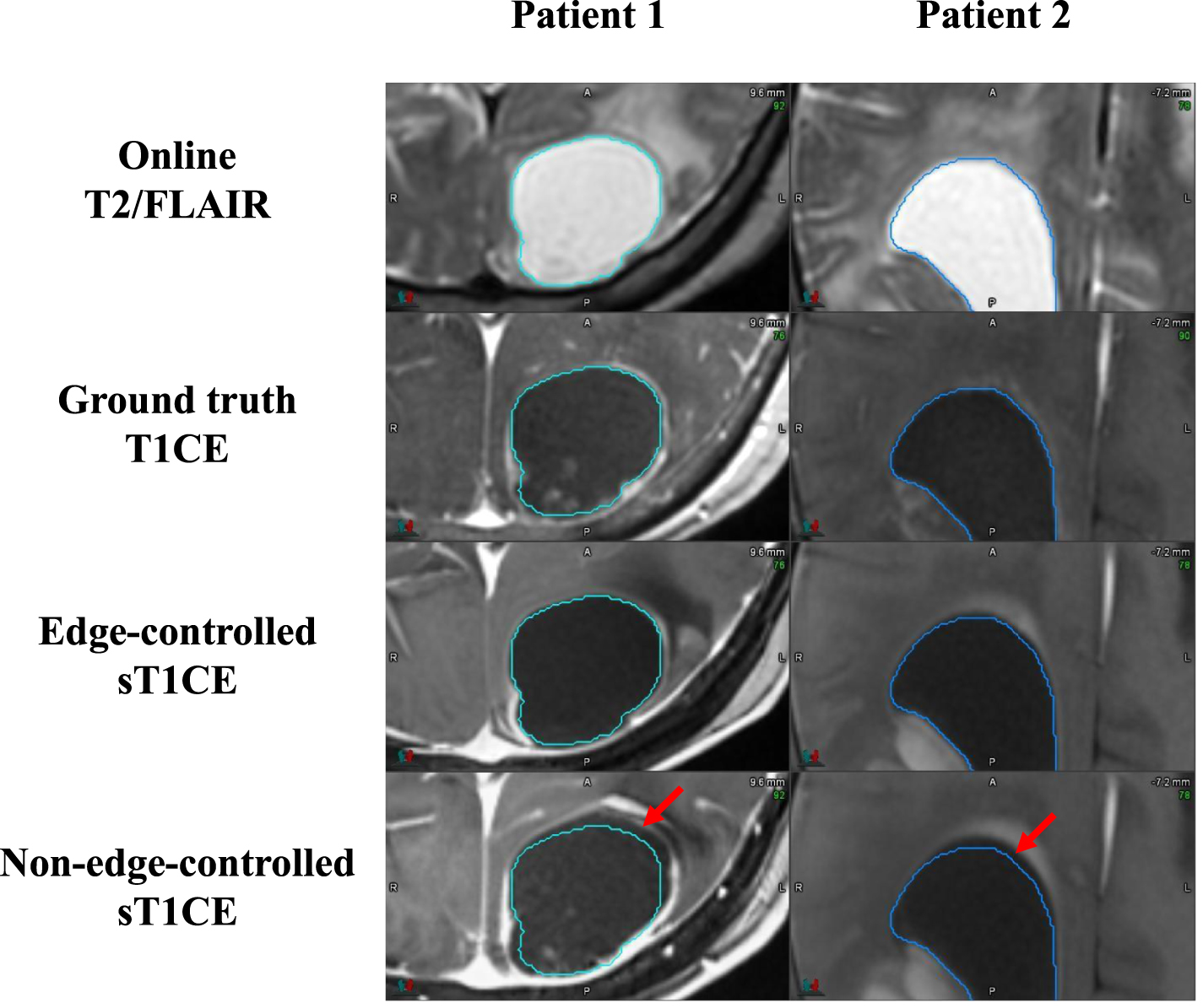 Contrast-enhanced image synthesis using latent diffusion model for ...