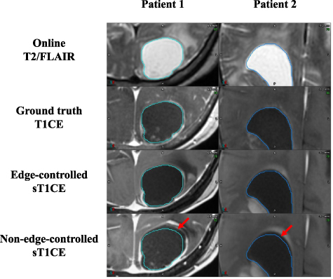 Contrast-enhanced image synthesis using latent diffusion model for ...