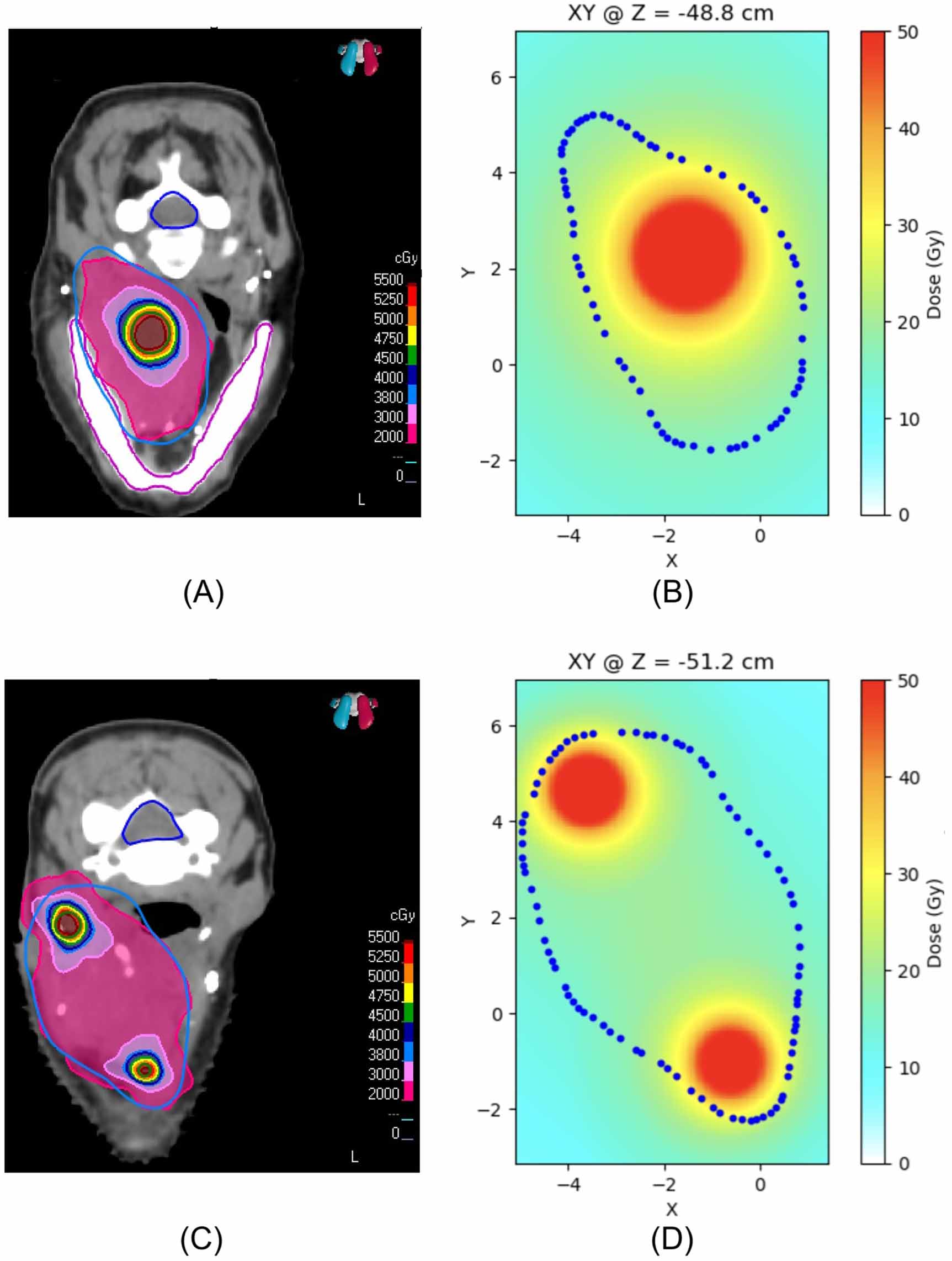 Geometric optimization of dose distribution in spatially fractionated ...