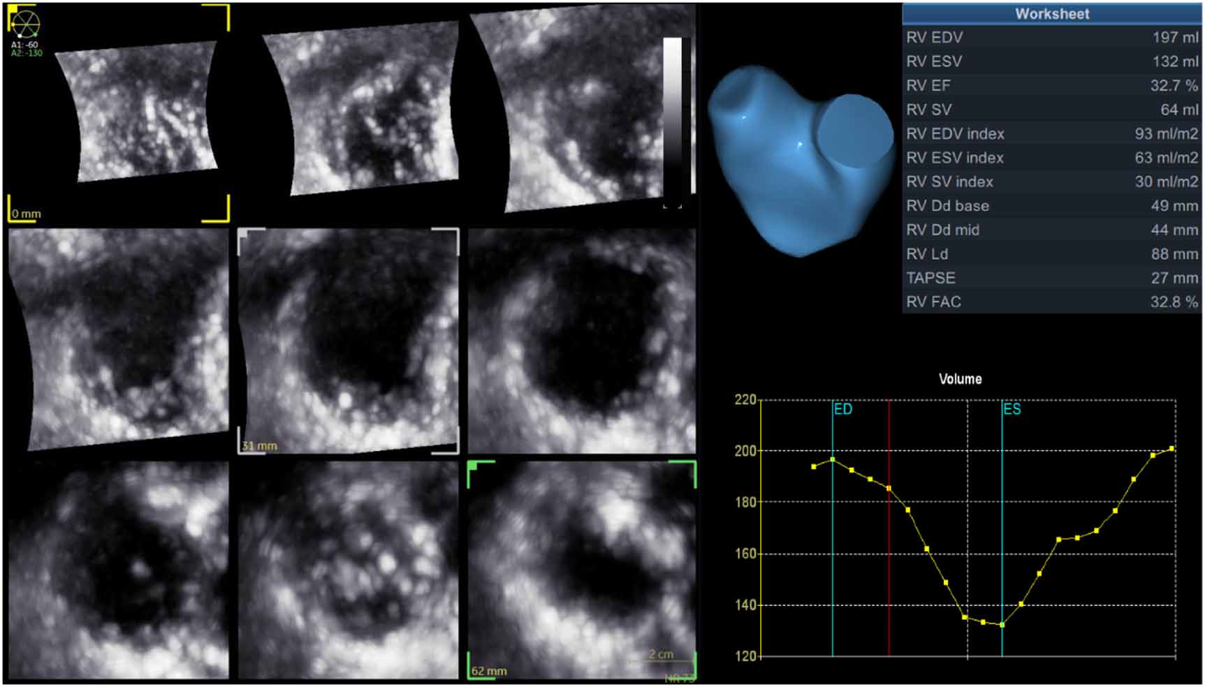 Three-dimensional ultrasound imaging: a review of the technology ...