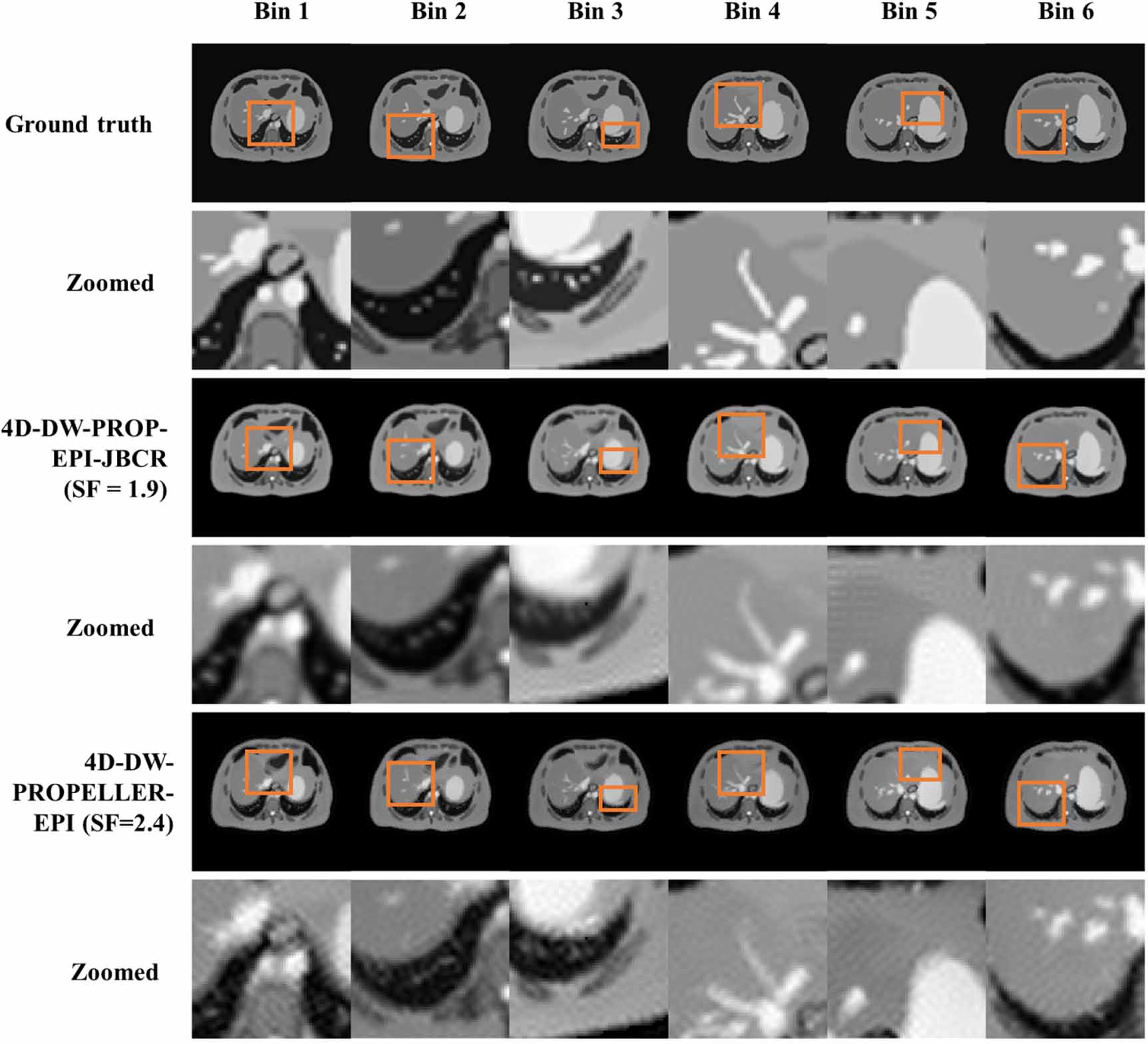 Enhanced 4D diffusion-weighted PROPELLER echo-planar imaging with ...