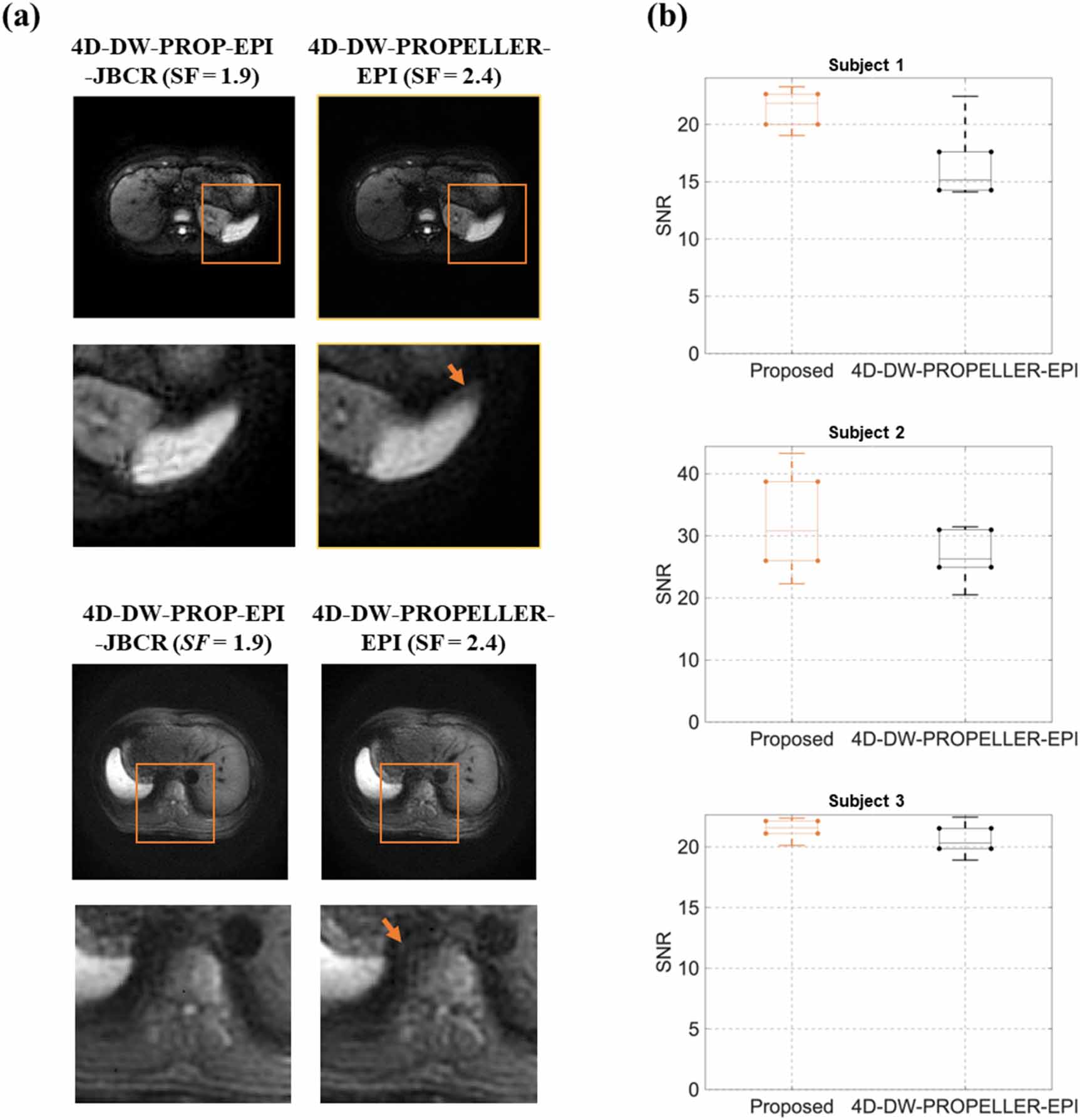 Enhanced 4D diffusion-weighted PROPELLER echo-planar imaging with ...