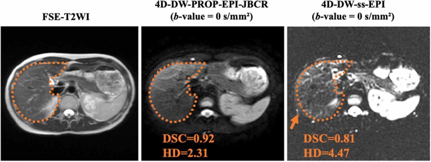 Enhanced 4D diffusion-weighted PROPELLER echo-planar imaging with ...
