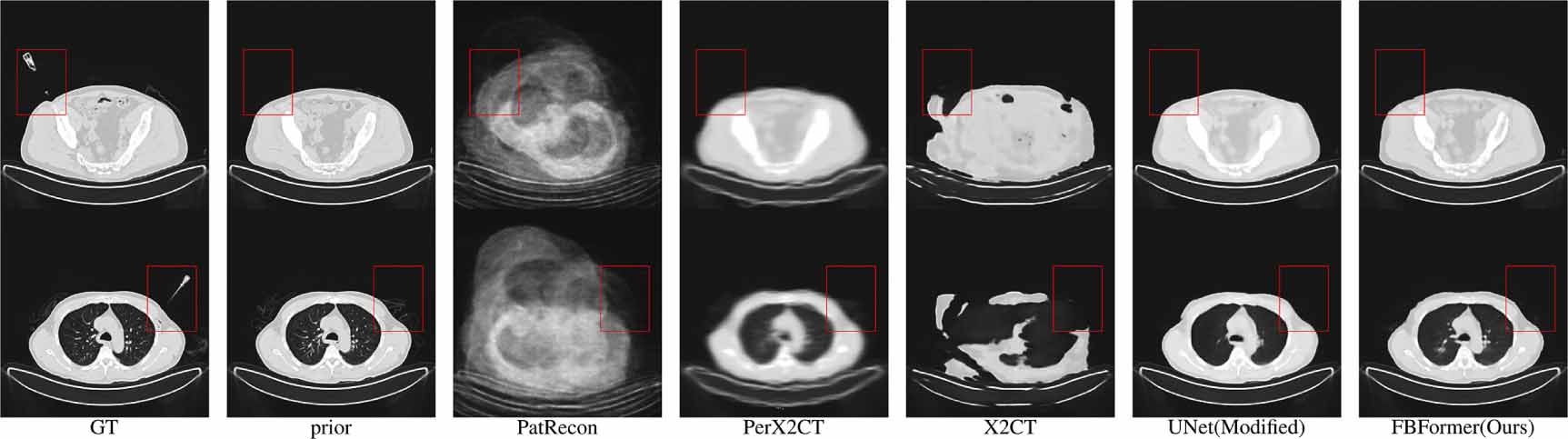 FBFormer: interventional ultra-sparse CT reconstruction with image ...