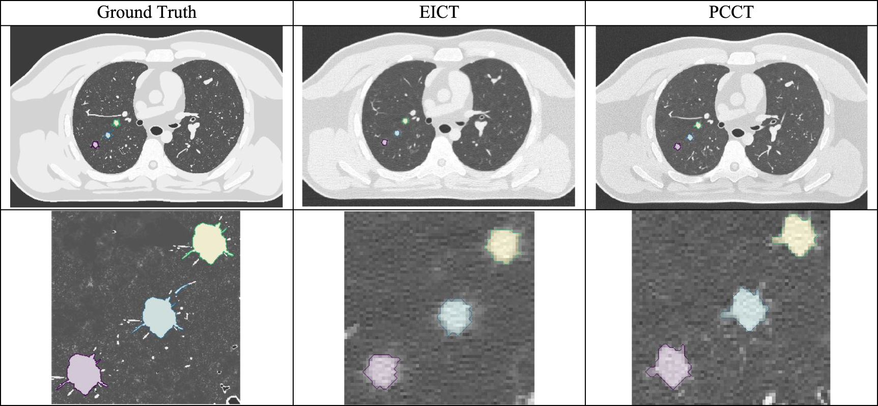 Ct Image Complex Example The potential of photon-counting CT for the improved precision of lung ...