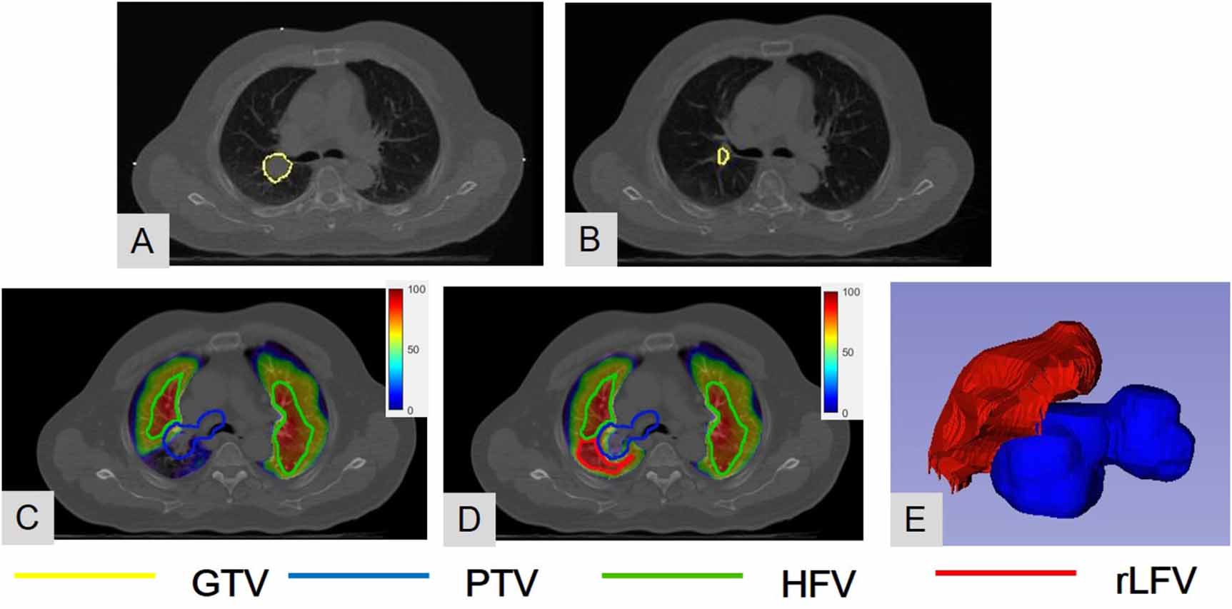 Anatomy-wise lung ventilation imaging for precise functional lung ...