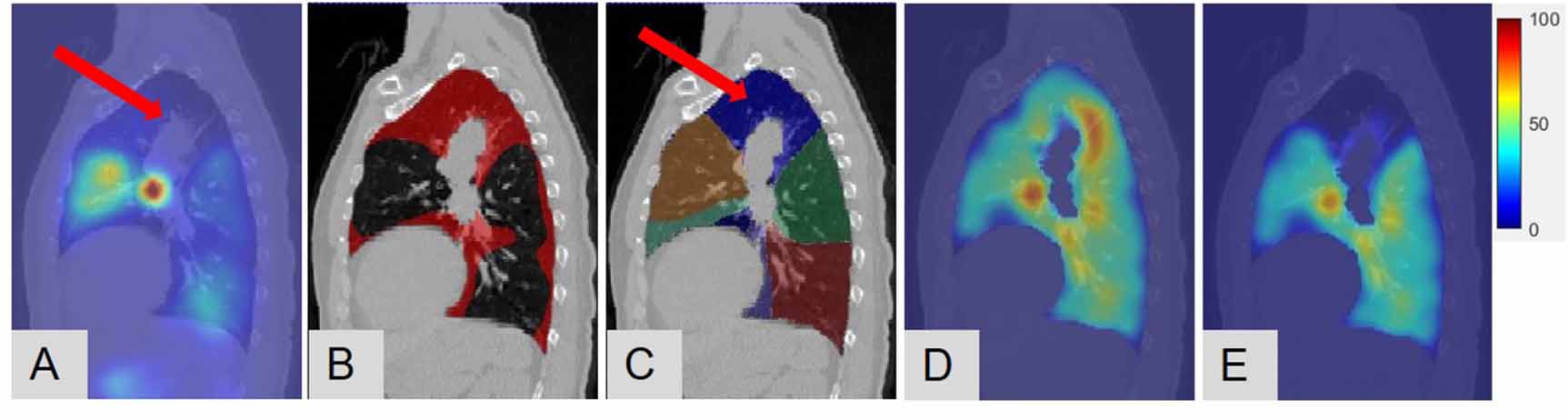 Anatomy-wise lung ventilation imaging for precise functional lung ...