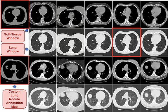 Guided synthesis of annotated lung CT images with pathologies using a ...