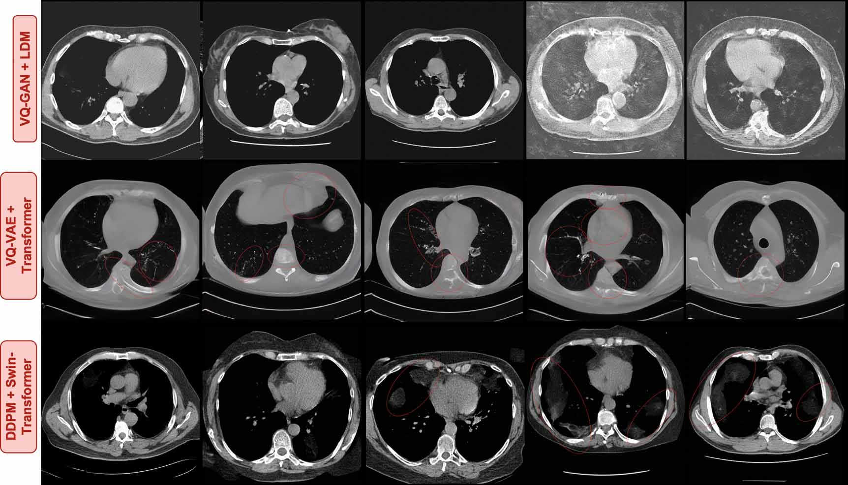 Guided synthesis of annotated lung CT images with pathologies using a ...