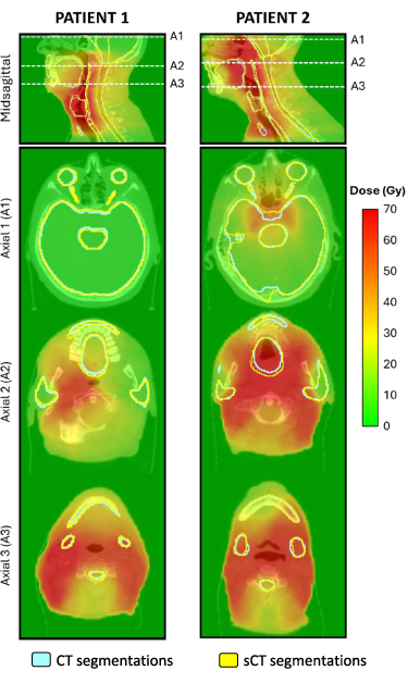 Deep learning-based segmentation of head and neck organs at risk on ...