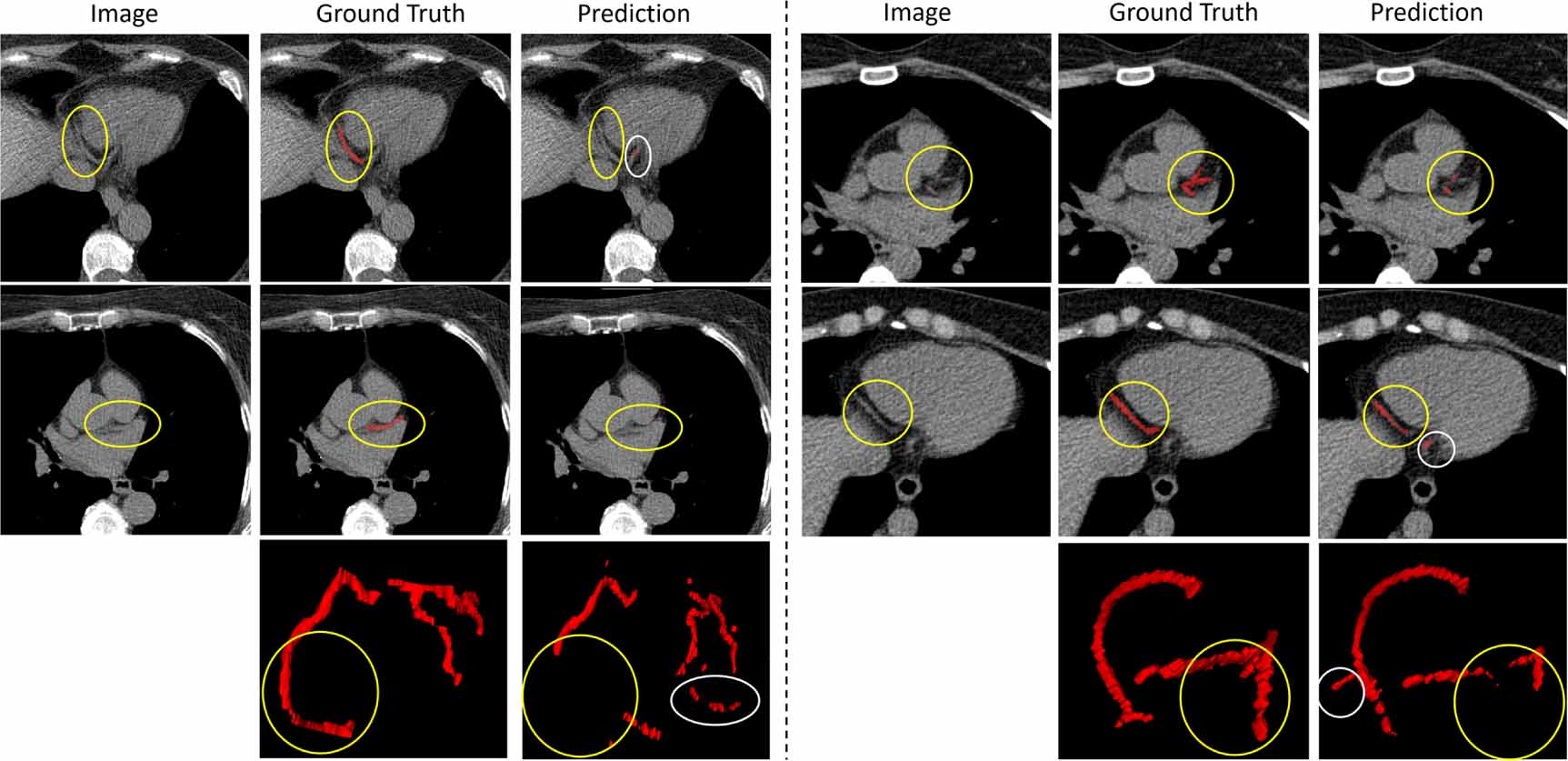 Coronary artery segmentation in non-contrast cardiac CT using anatomy ...