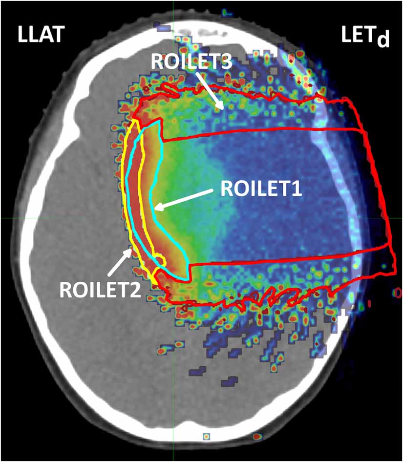 Reducing pitfalls in composite plan evaluations of dose-weighted linear ...