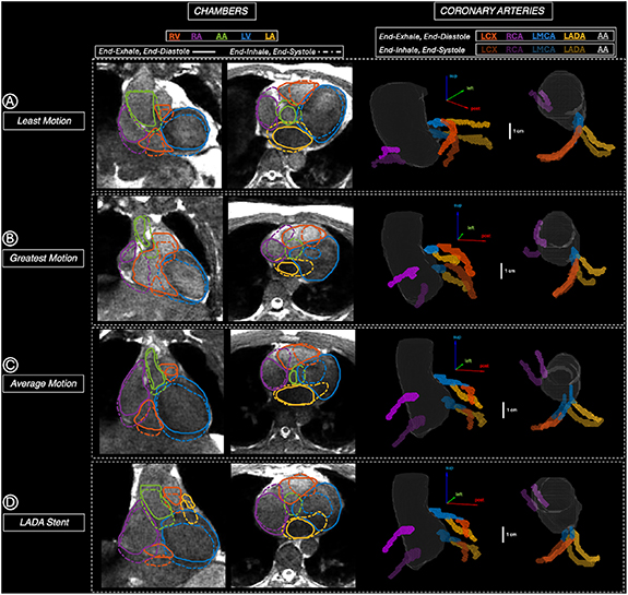 Deducing cardiorespiratory motion of cardiac substructures using a ...