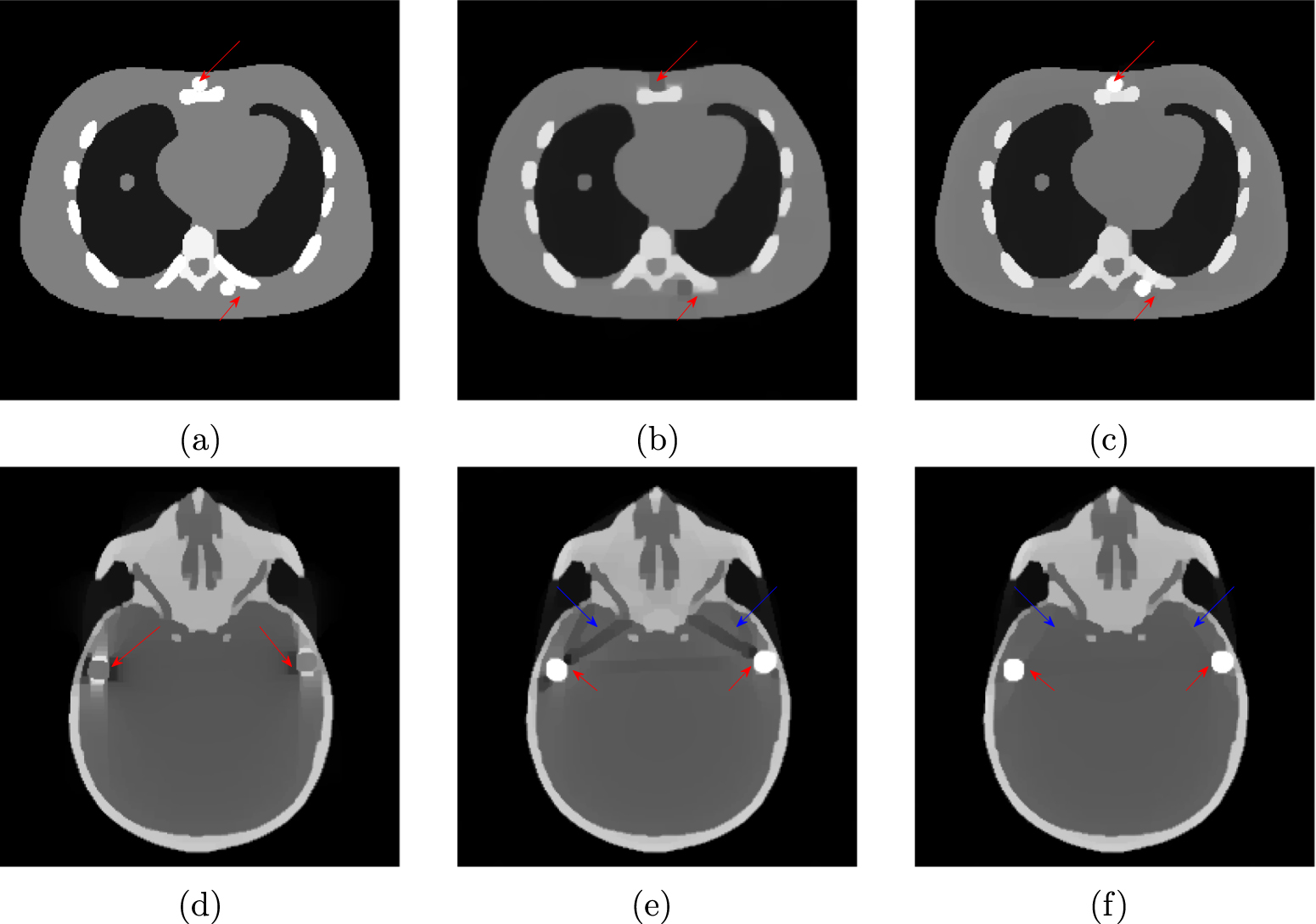 Nonconvex weighted variational metal artifacts removal via convergent ...