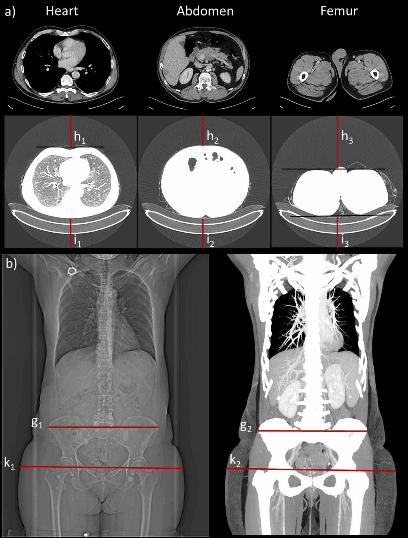 Influence of tube and patient positioning in thoracoabdominal CT ...