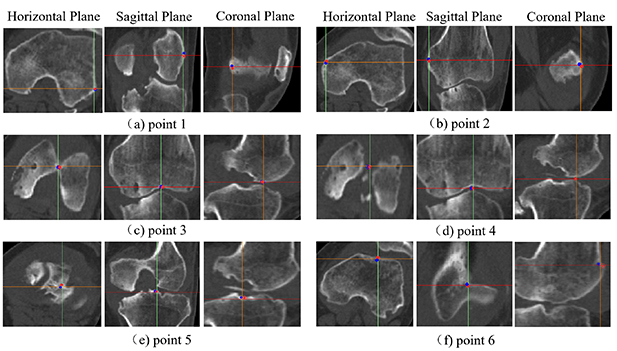 Bone Ridge Mapping Bone anatomical landmark localization with cascaded spatial ...