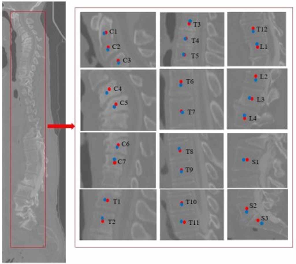 Bone anatomical landmark localization with cascaded spatial ...