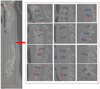 Bone anatomical landmark localization with cascaded spatial ...