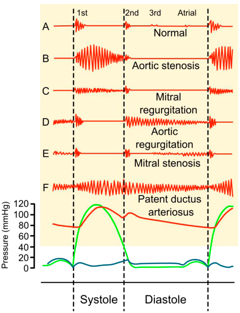 An open access database for the evaluation of heart sound algorithms ...