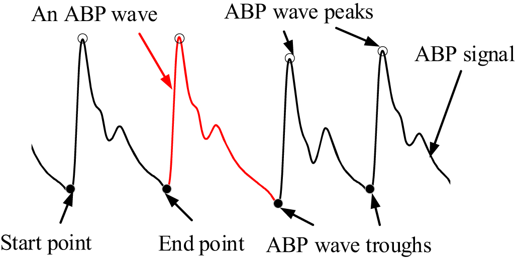 A recognition method for extreme bradycardia by arterial blood pressure ...
