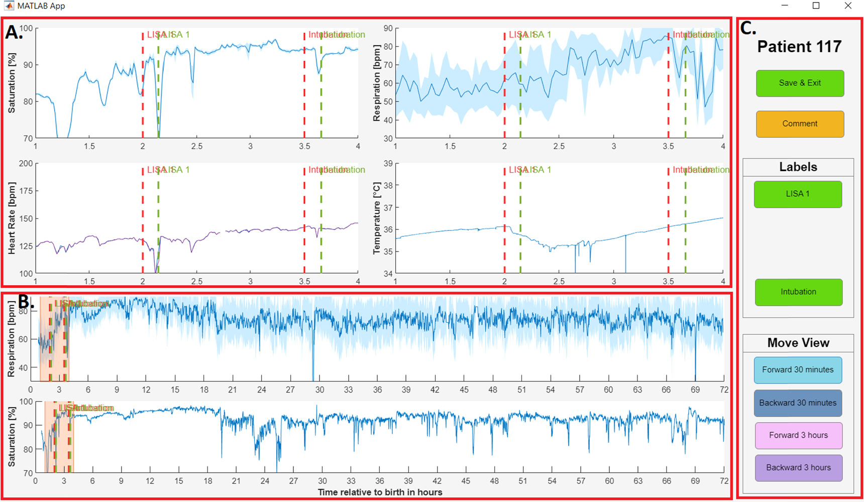 Lisa Method Predicting CPAP failure after less invasive surfactant administration ...