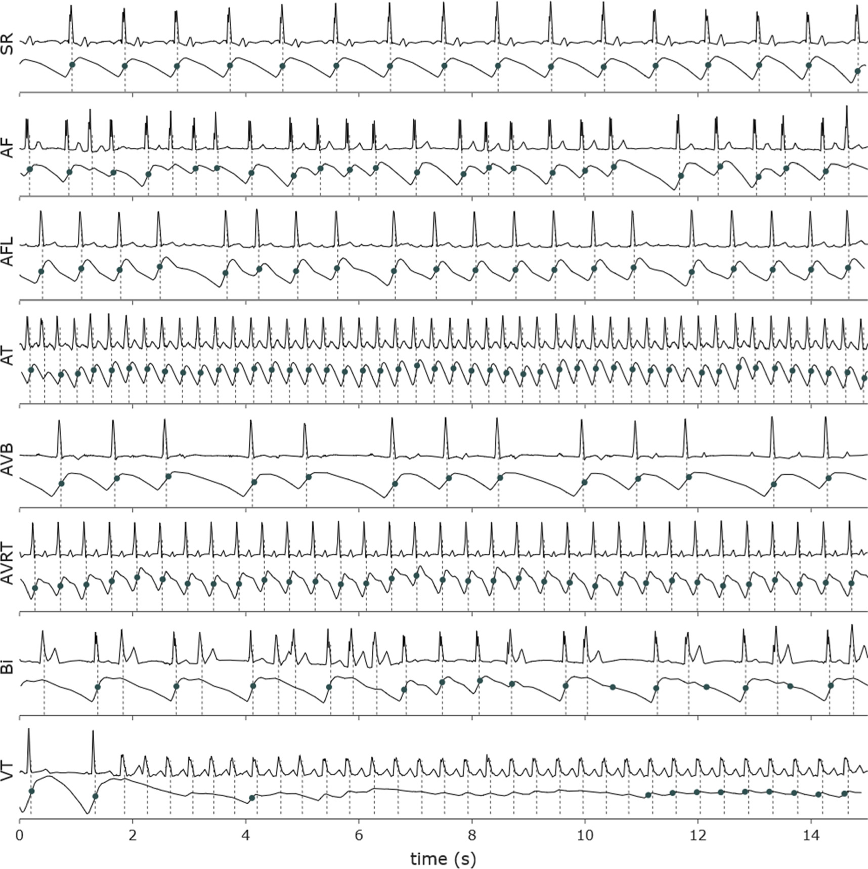 The influence of cardiac arrhythmias on the detection of heartbeats in ...