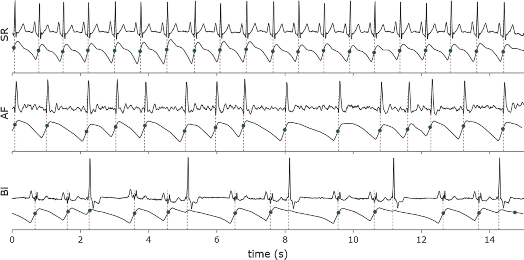 The influence of cardiac arrhythmias on the detection of heartbeats in ...