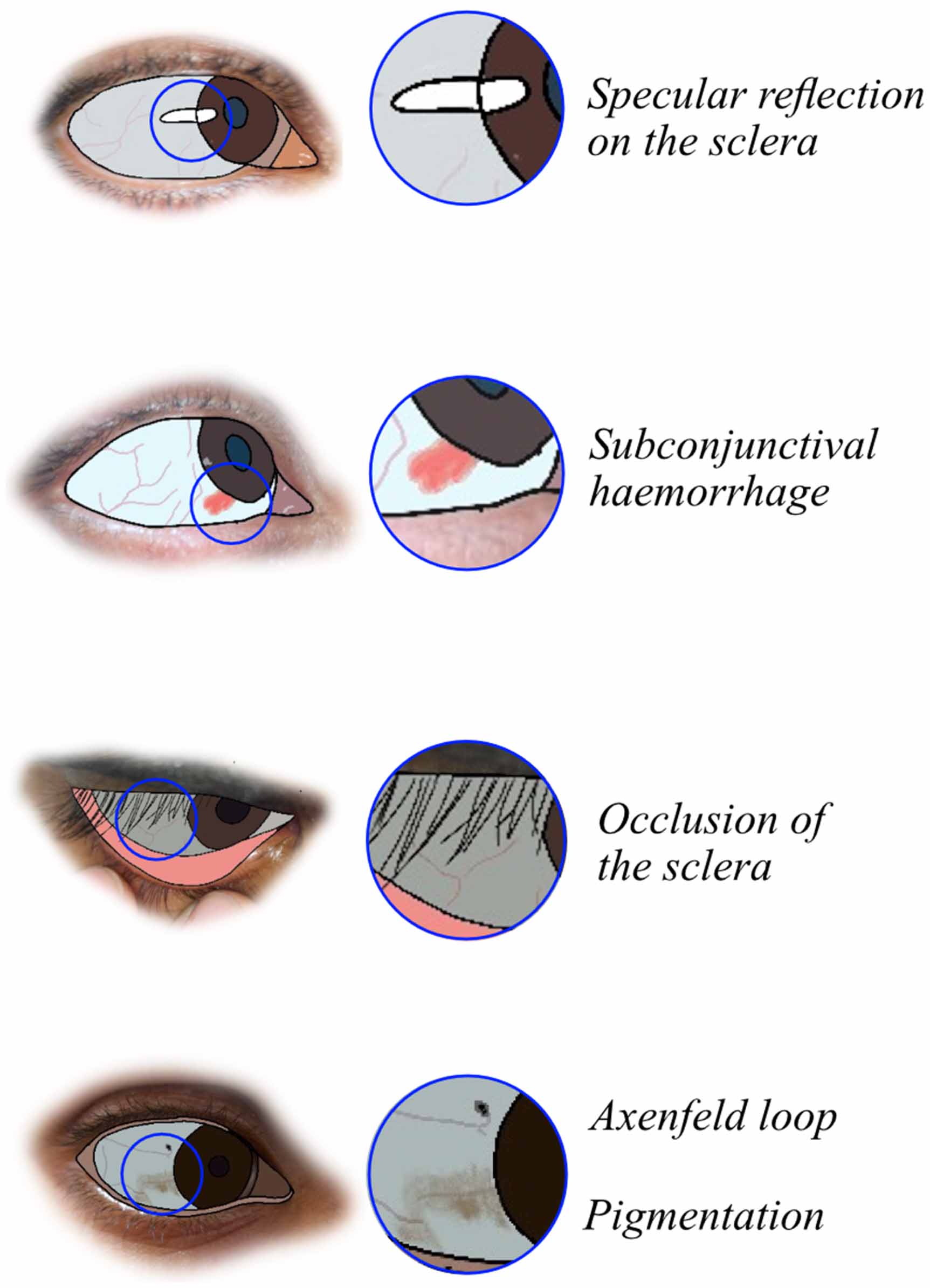 Diagnosing anaemia via smartphone colorimetry of the eye in a ...