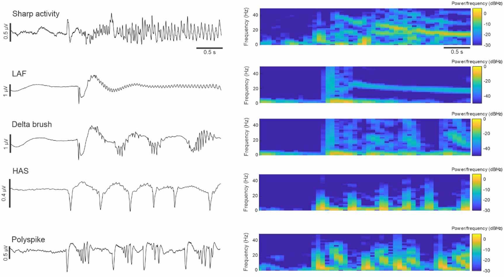 Laf Pattern Automated classification of seizure onset pattern using intracranial ...