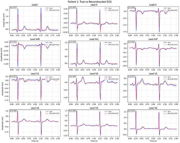 Four-electrode ECG reconstruction using anatomically grounded synthetic ...