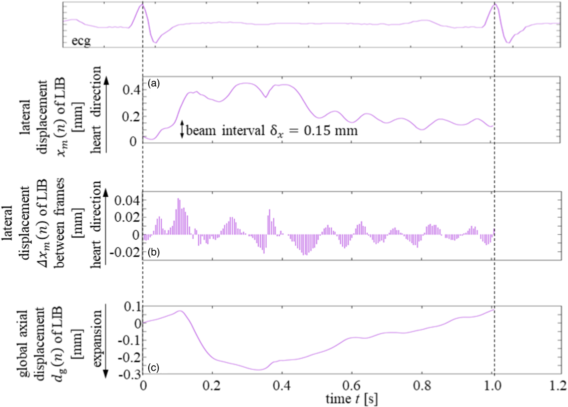 Ultrasonic measurement of thickness of carotid arterial wall using its ...