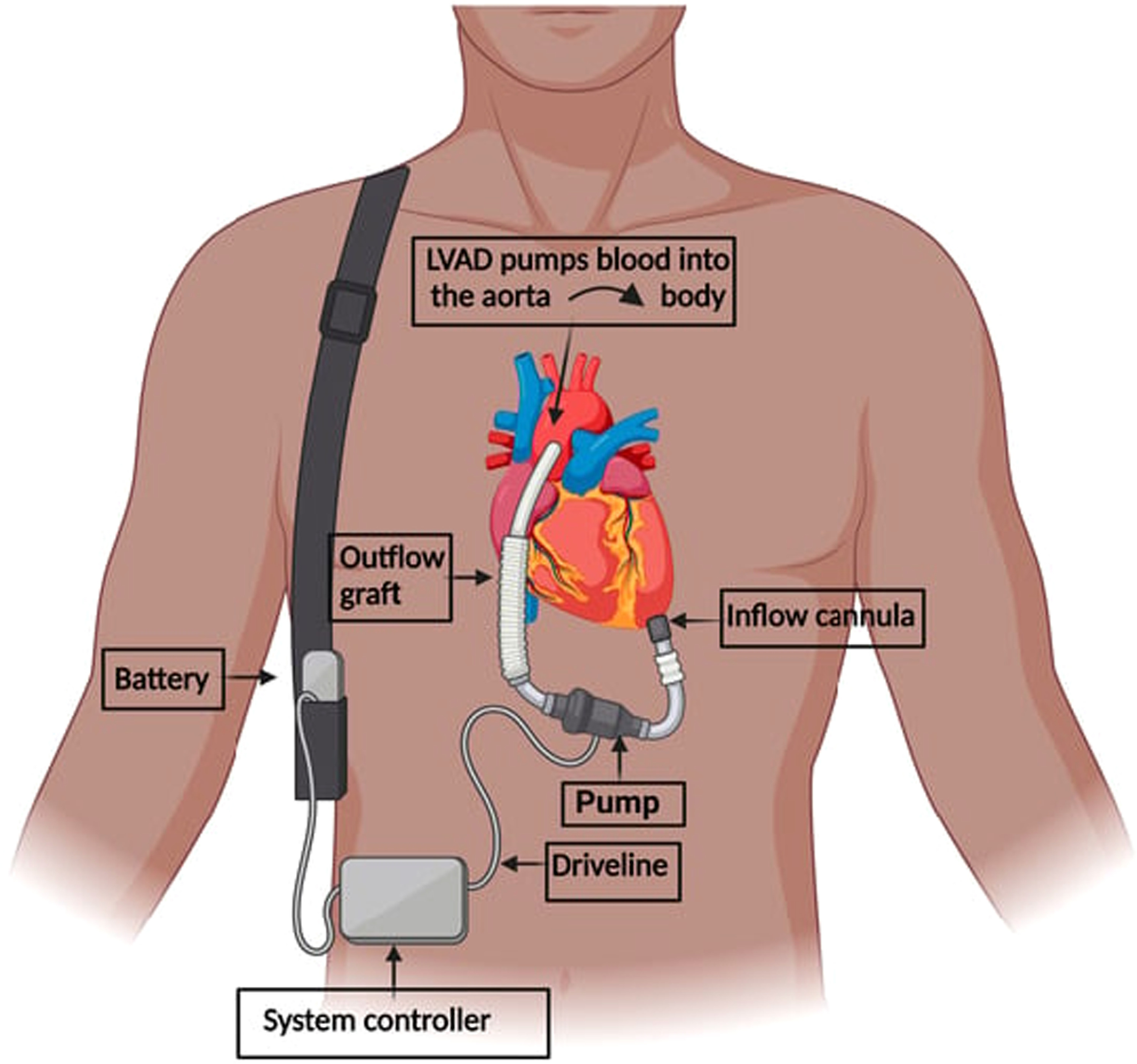 Mcs Device Mechanical circulatory support systems with dual-drive architecture: a ...