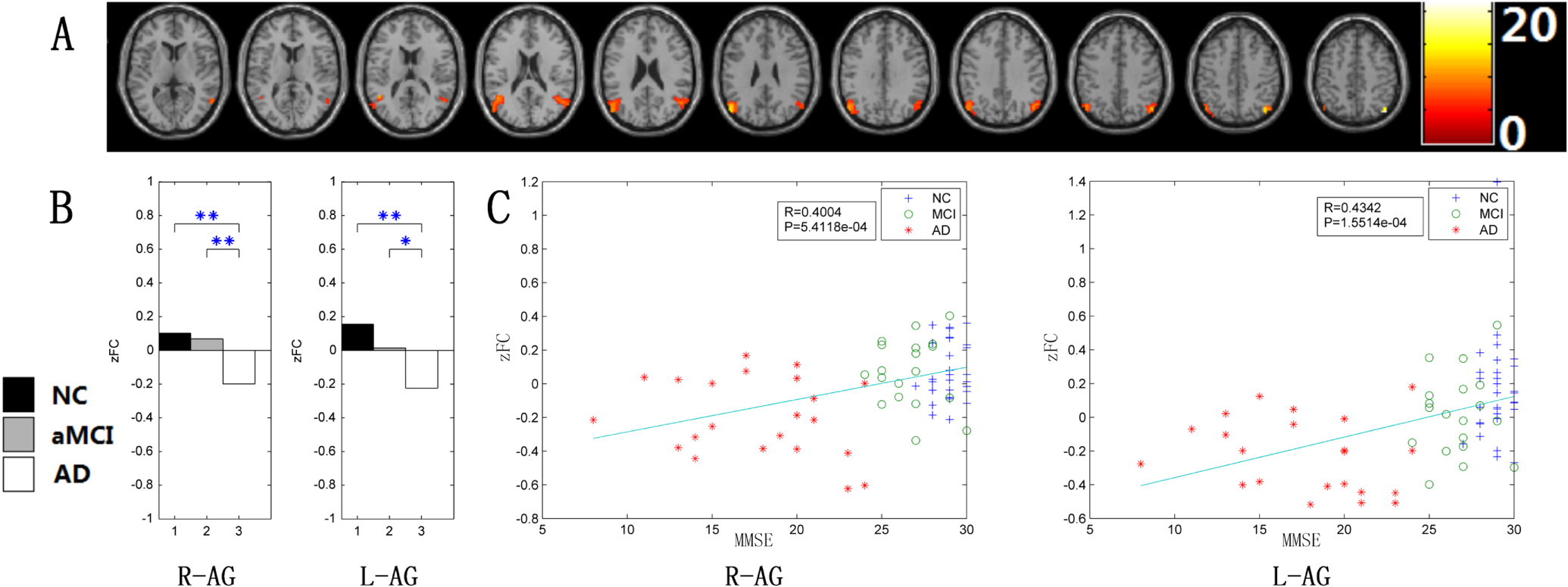 Changes of intranetwork and internetwork functional connectivity in ...
