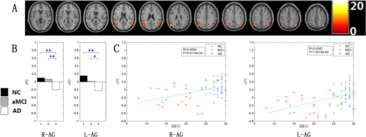 Changes of intranetwork and internetwork functional connectivity in ...