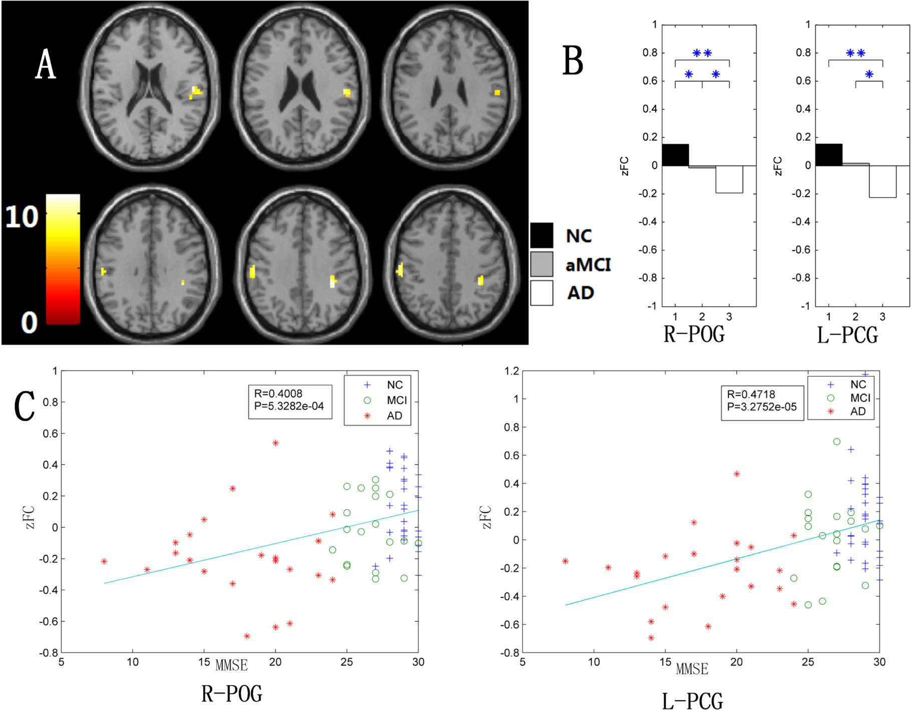 Changes of intranetwork and internetwork functional connectivity in ...