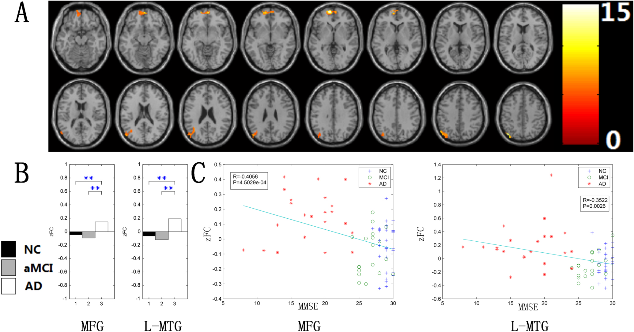 Changes of intranetwork and internetwork functional connectivity in ...