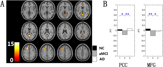 Changes of intranetwork and internetwork functional connectivity in ...