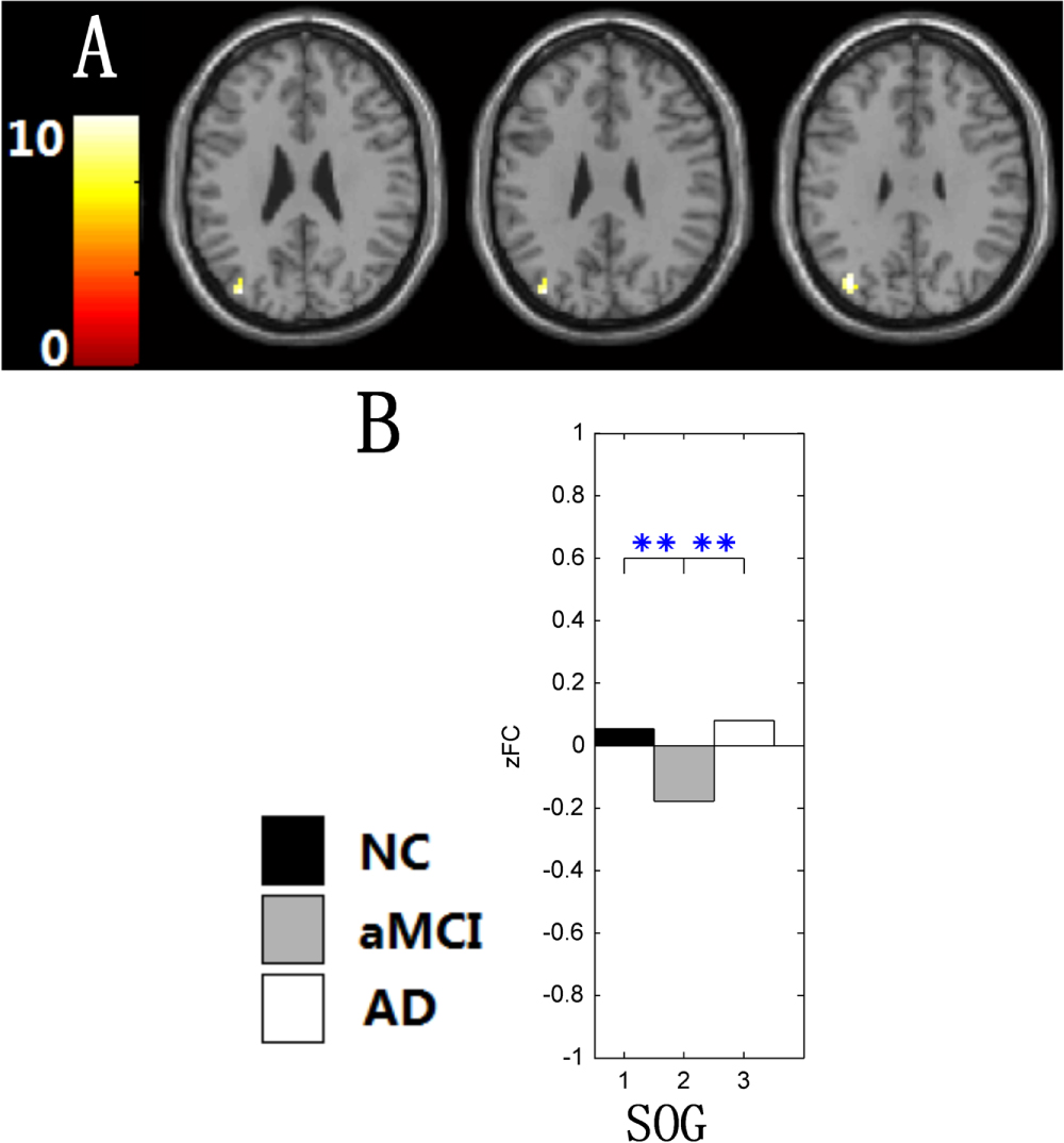 Changes of intranetwork and internetwork functional connectivity in ...
