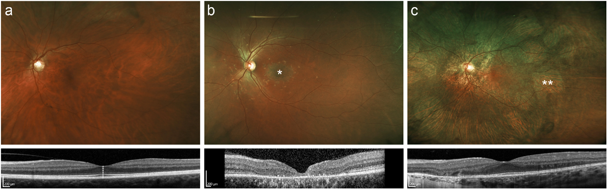 Gene therapy for inherited retinal degenerations: initial successes and ...