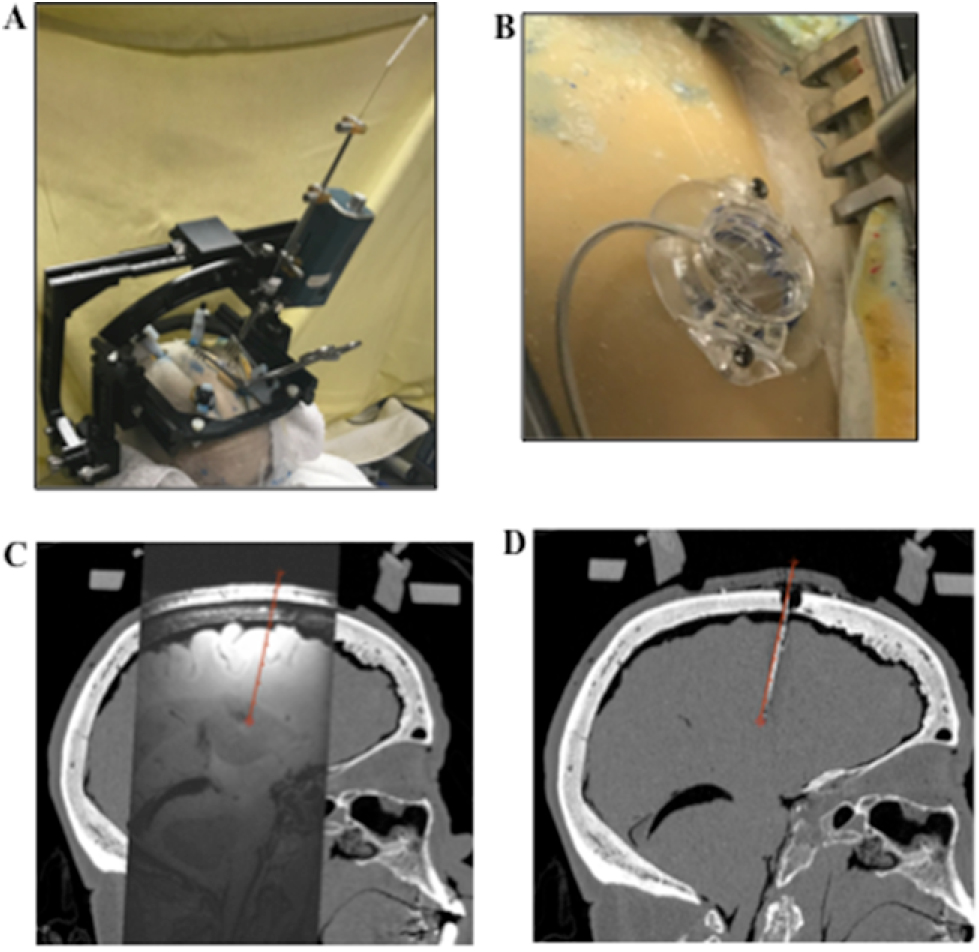Starfix Frame A novel re-attachable stereotactic frame for MRI-guided neuronavigation ...