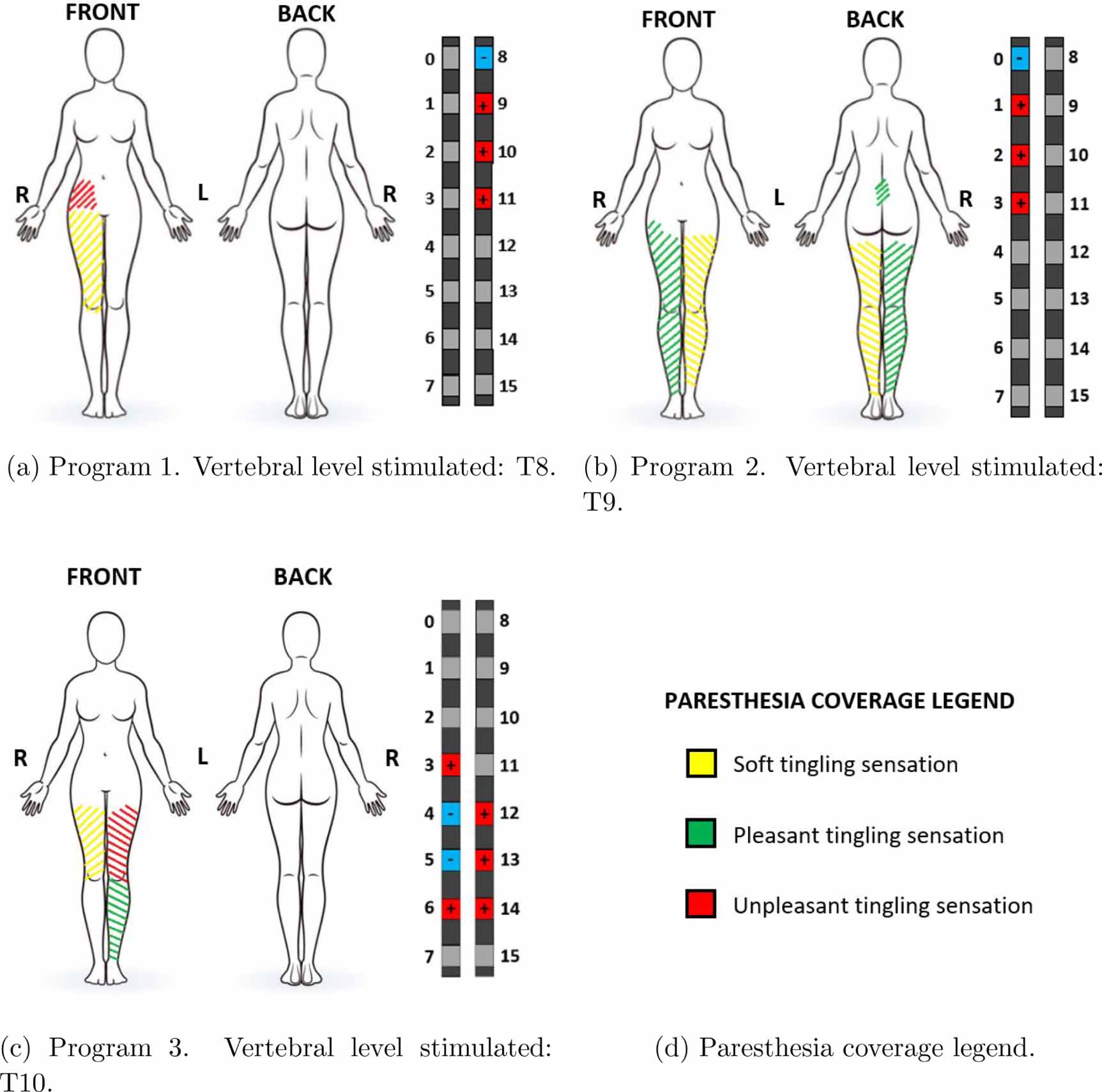 3D patient-specific spinal cord computational model for SCS management ...