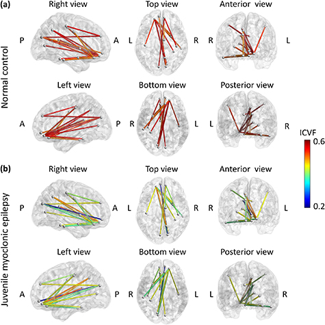 White matter structural connectivity as a biomarker for detecting ...