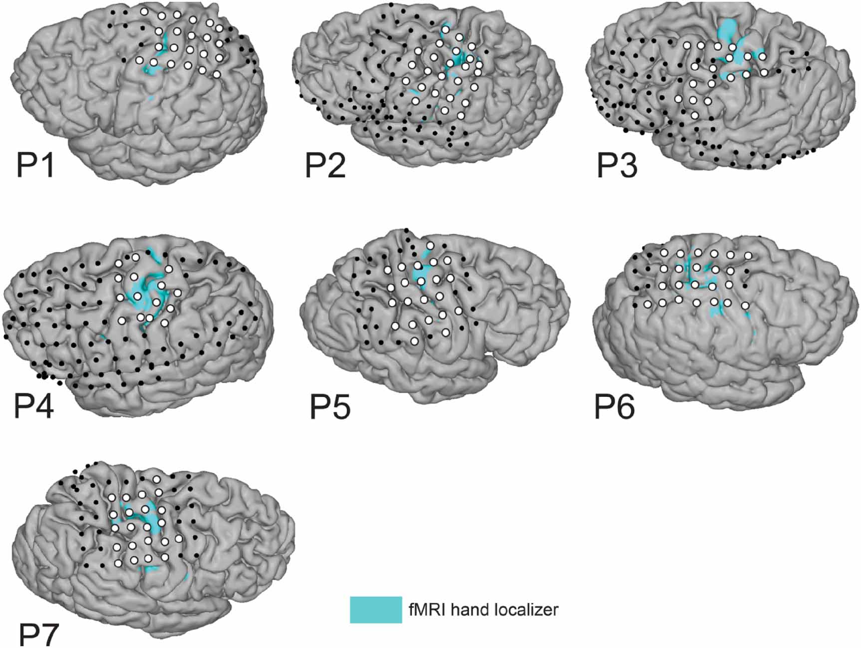 Decoding four hand gestures with a single bipolar pair of  electrocorticography electrodes - IOPscience