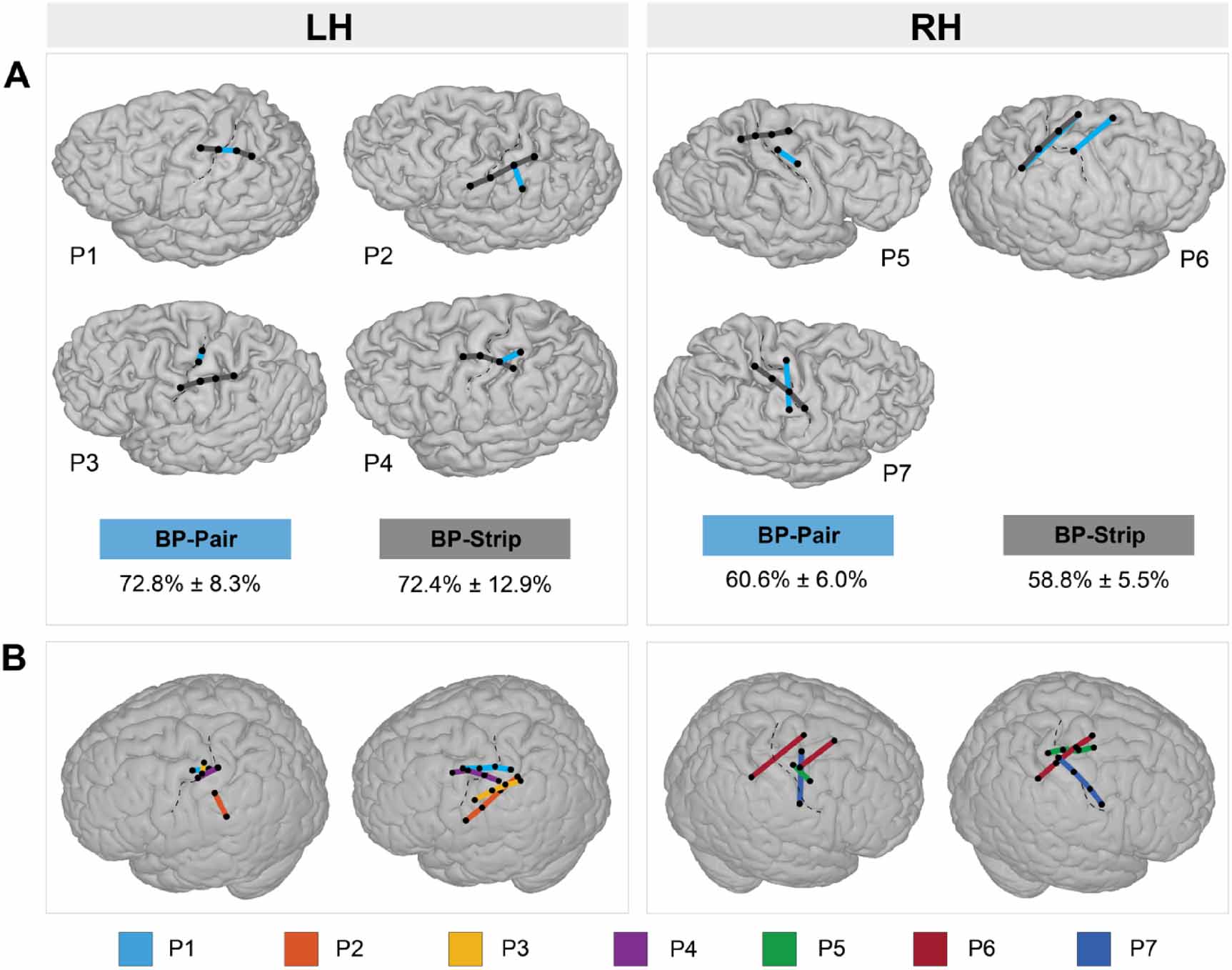 Decoding four hand gestures with a single bipolar pair of  electrocorticography electrodes - IOPscience